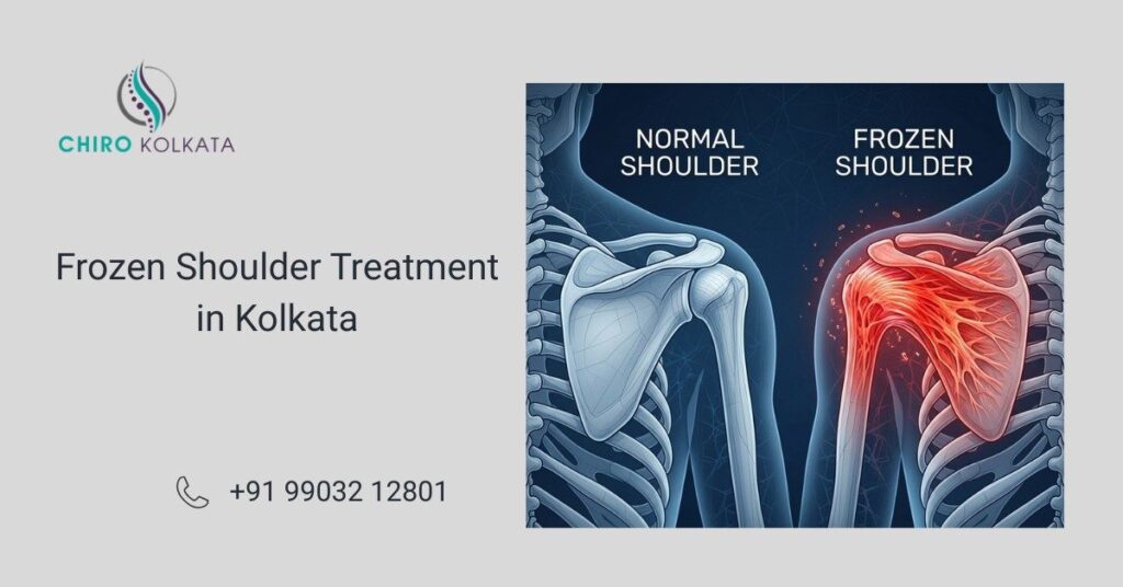 Frozen Shoulder Treatment in Kolkata